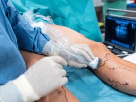 Збереження здоров'я ніг: Безкоштовні консультації судинного хірурга та флеболога в Краматорську