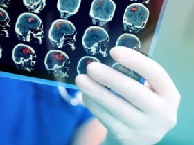 Інсульт, фактори ризику та профілактика